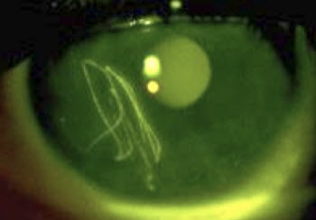 Corneal abrasion