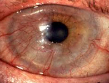 Corneal neovascularization